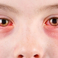 Por qué pican los ojos?
